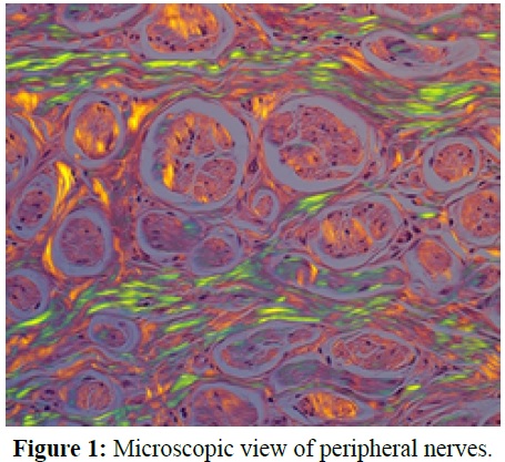 Neuroma