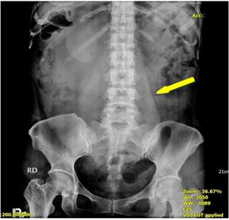 Huge Ovarian Borderline Mucinous Cystadenoma