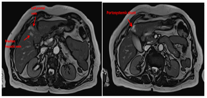 Congenital Portosystemic Shunt