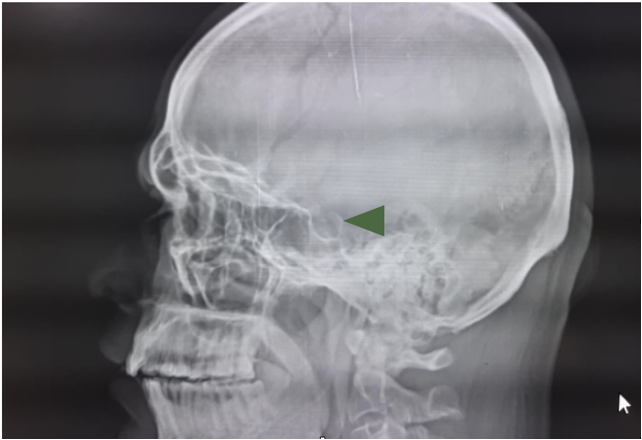 Skull X-Ray Lateral View Used as a Screening Tool in Suspected Case of Pituitary Macro Adenoma