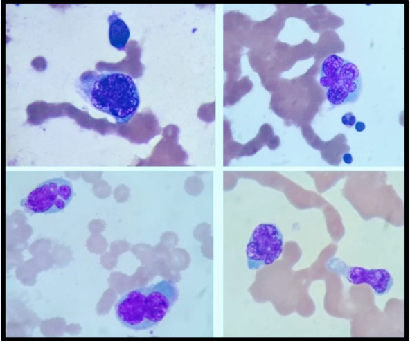 Anaplastic Plasma Cell Myeloma A Morphological Dilemma