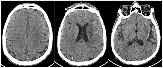 Cortical Laminar Necrosis