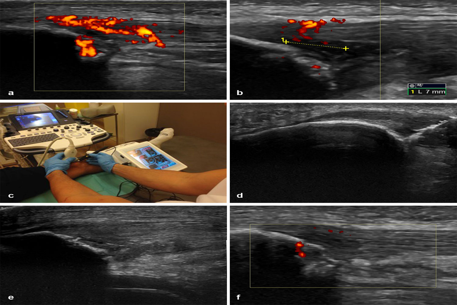 Intratissue Percutaneous Electrolysis (Epi®) in the Treatment of Patellar Tendinopathy