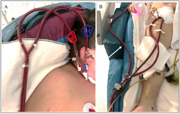 Simplified Veno-Arterio-Venous ECMO as Bailout Therapy in a Patient with Cardiogenic Shock and Pulmonary Failure