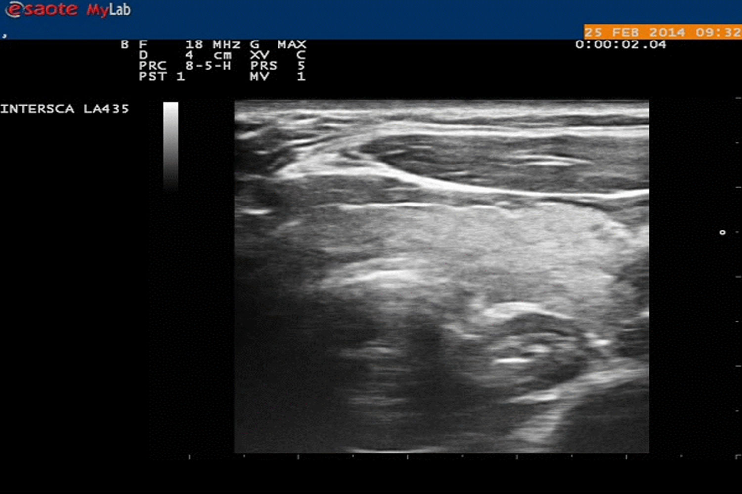 A Real-Time, Moving Sonographic Image of  Esophagus During Swallowing