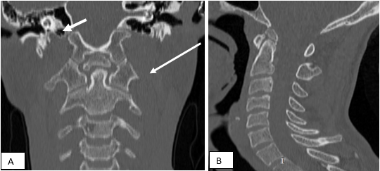 Odentoideum Bone and Not a Fracture