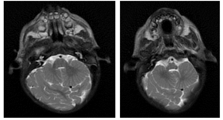 Rhombencephalosynapsis: An Uncommon Cerebellar Malformation