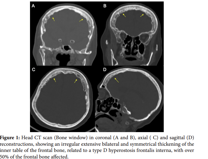 Hyperostosis Frontalis Interna