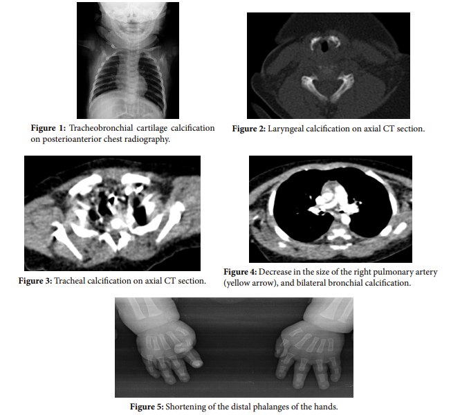 Rare cause of respiratory distress in newborn: Laryngotracheobronchial cartilage calcification