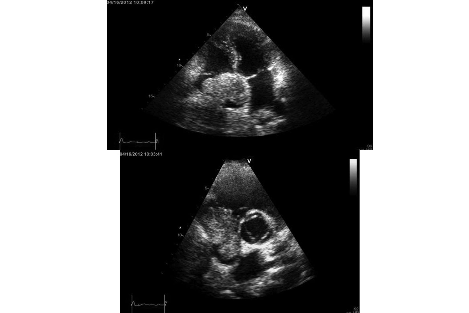 Right Atrial Mass In A Patient With HIV & Hepatitis B