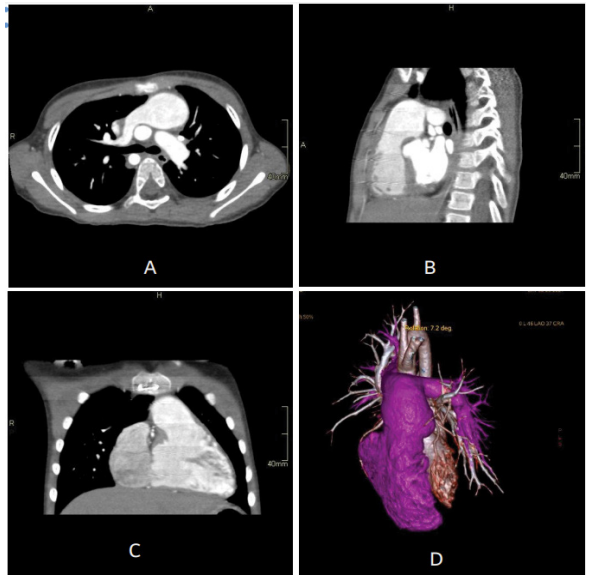 MPA Aneurysm