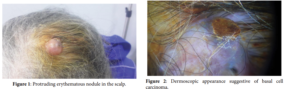 A Disconcerting Case of a Nodular Hidradenoma of the Scalp Simulating a Basal Cell Carcinoma