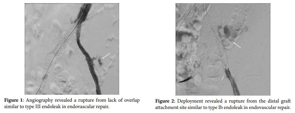 Management of Iliac Artery Rupture in Endovascular Treatment Based on the Endoleak-type System