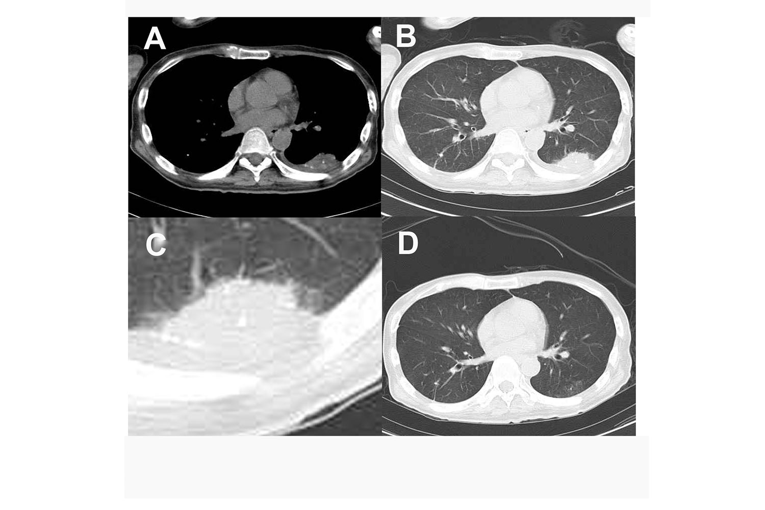 Delayed Pneumonia Caused By Nonionic Soluble Contrast Media