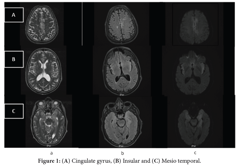 Herpetic encephalitis : typical ascpect