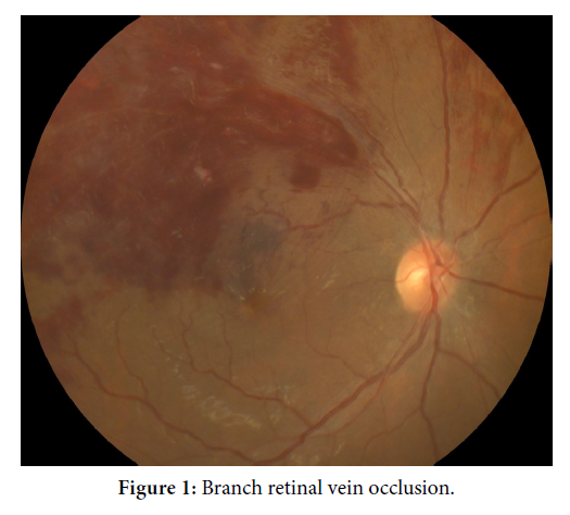 Branch Retinal Vein Occlusion