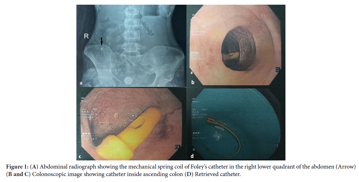 Intriguing Journey: Foley Catheterâs Intra-colonic Migration