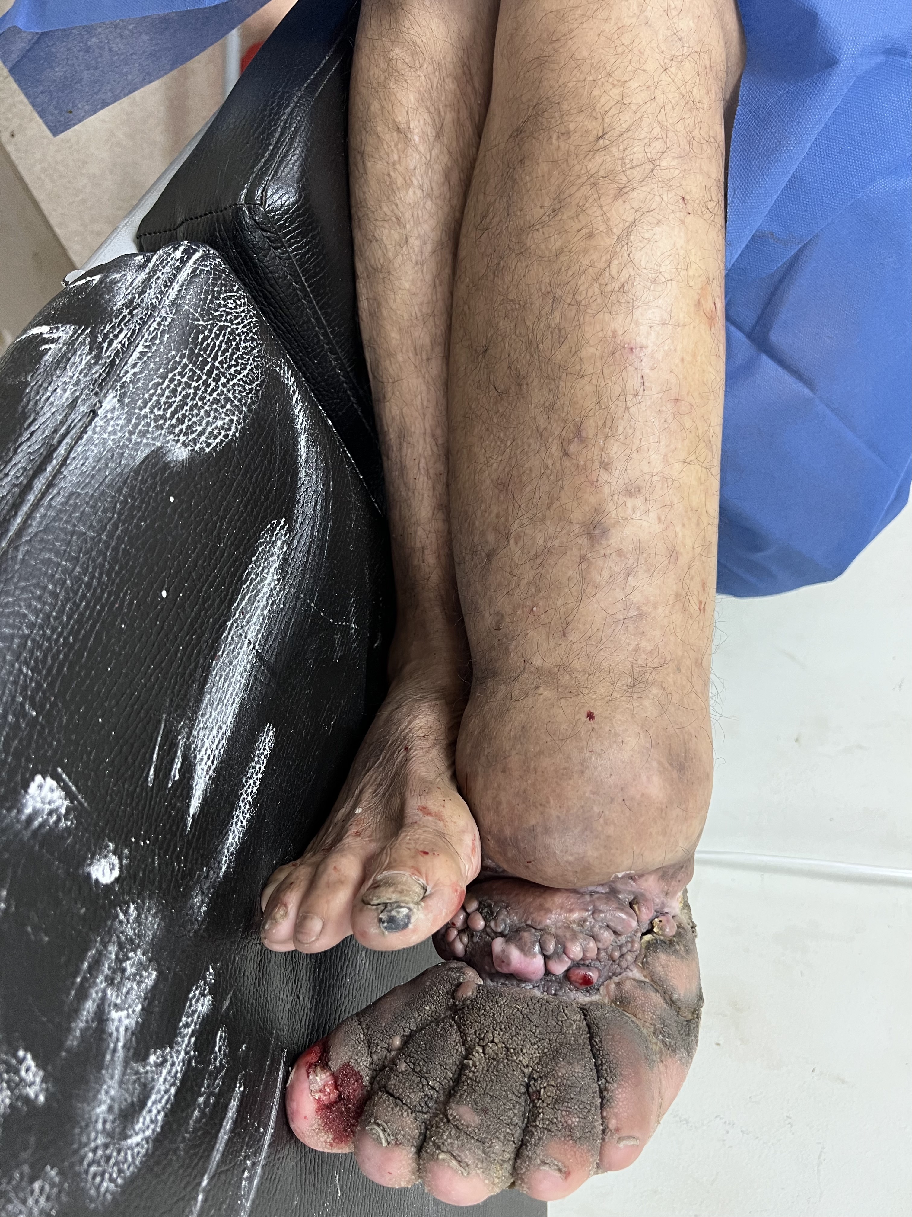 Lymphatic Filariasis