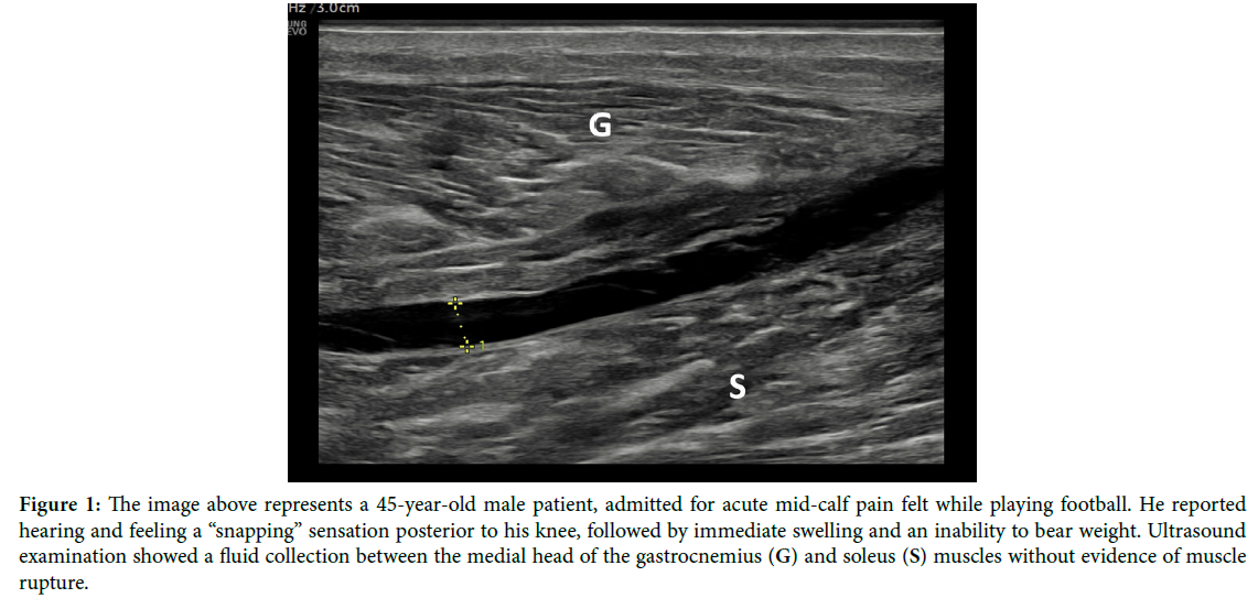 âTennis Legâ, When Ultrasound can make the Diagnosis