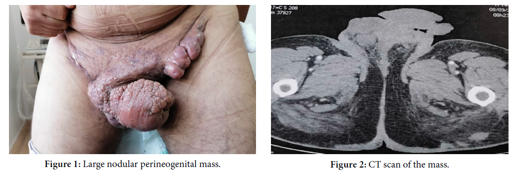 Hidradenitis Suppurativa: A Rare Clinical Image