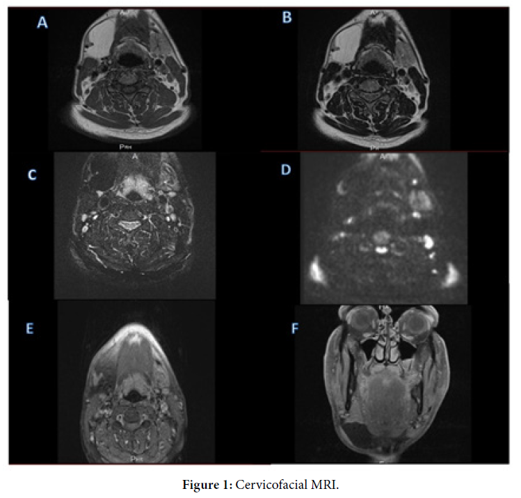 Submandibulair Gland Lipoma: An Uncommon Location