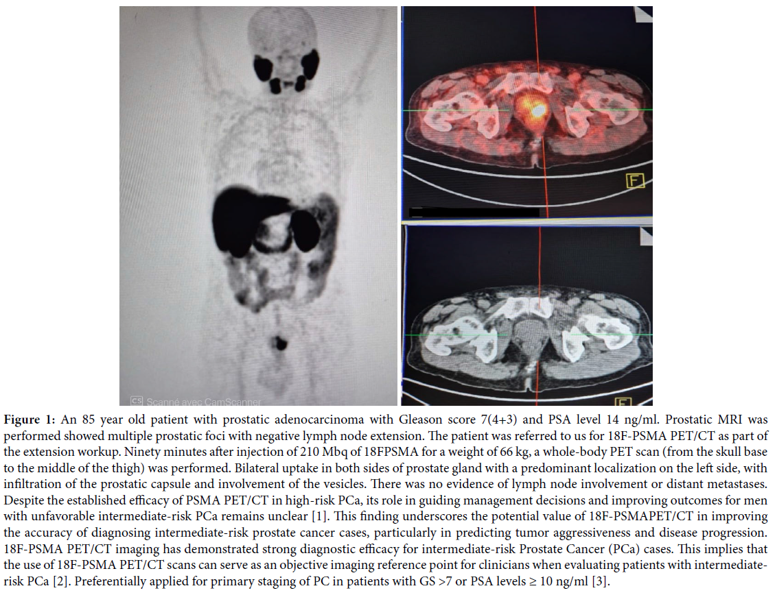 Contribution of 18F-PSMA PET/CT to the Extension Workup of Intermediate-Risk Prostatic ADK: A Case Report