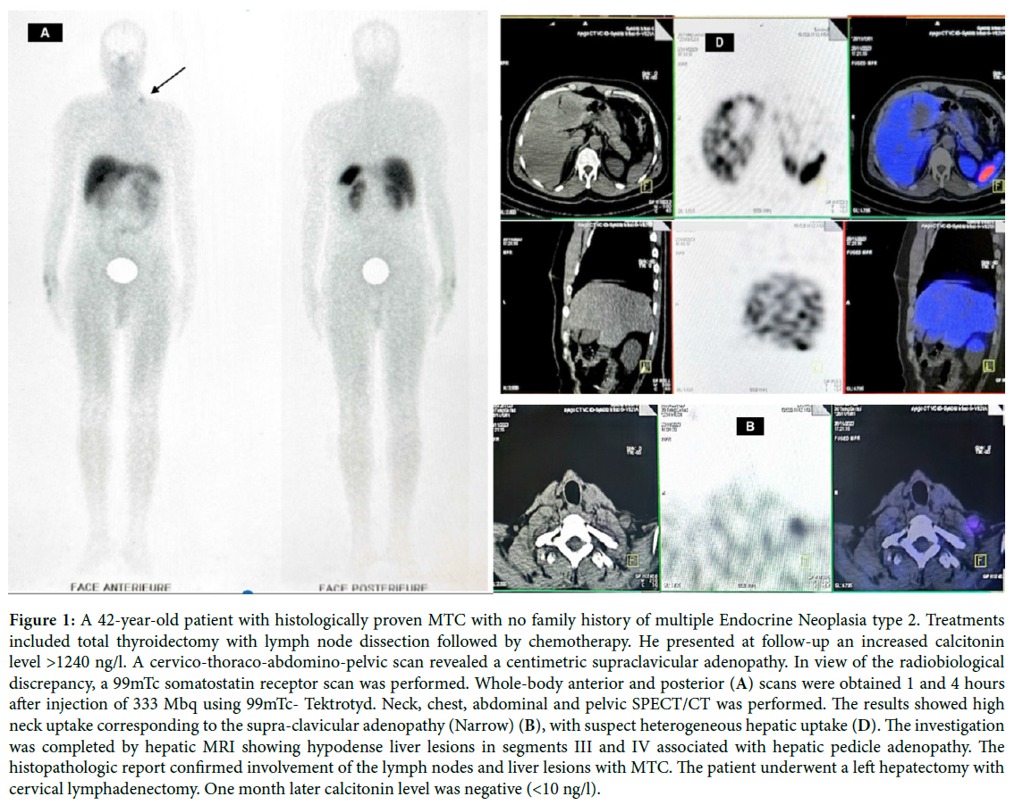 Comparison of Octreotide Scintigraphy and Conventional Imaging in Detection of Metastatic Medullary Thyroid Carcinoma Case Report