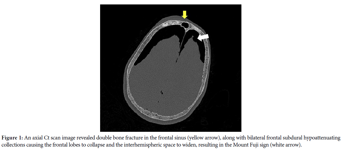 Tension Pneumocephalus and the Mount Fuji Sign: A Case Study and Review