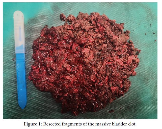 Urgent Transurethral Resection of a Massive Bladder Clot in a Hemodynamically Unstable Patient