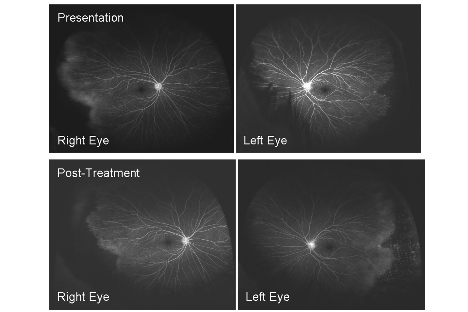 Ultra-widefield Fluorescein Angiography Of Familial Exudative Vitreoretinopathy