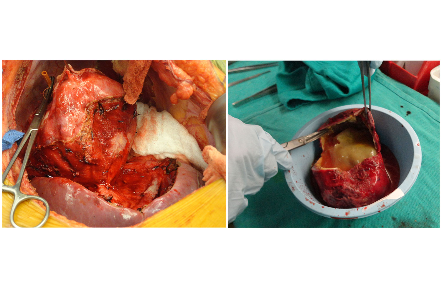 Echinococcal Liver Cyst