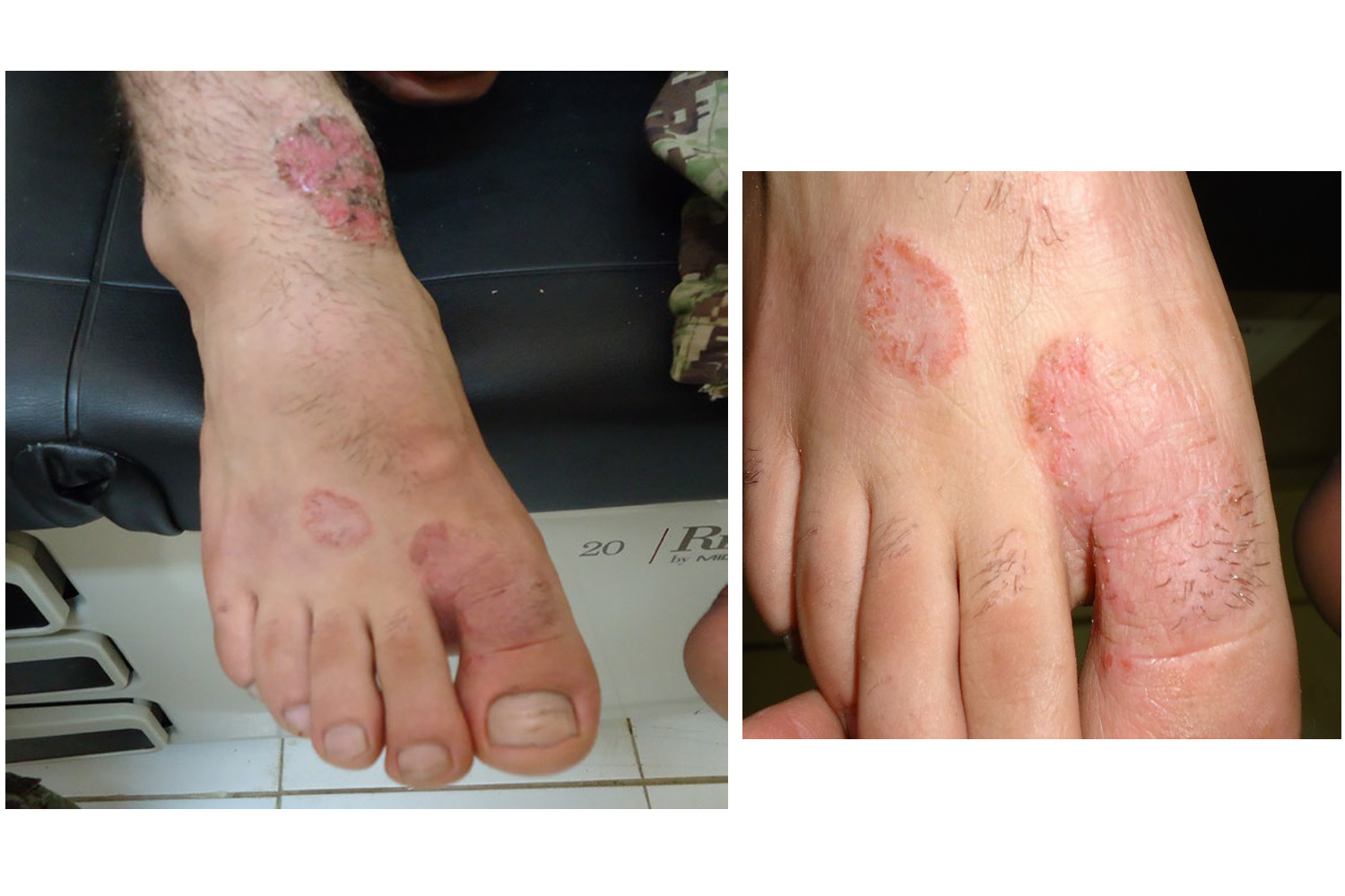 Tinea Pedis  International Journal of Clinical & Medical Images