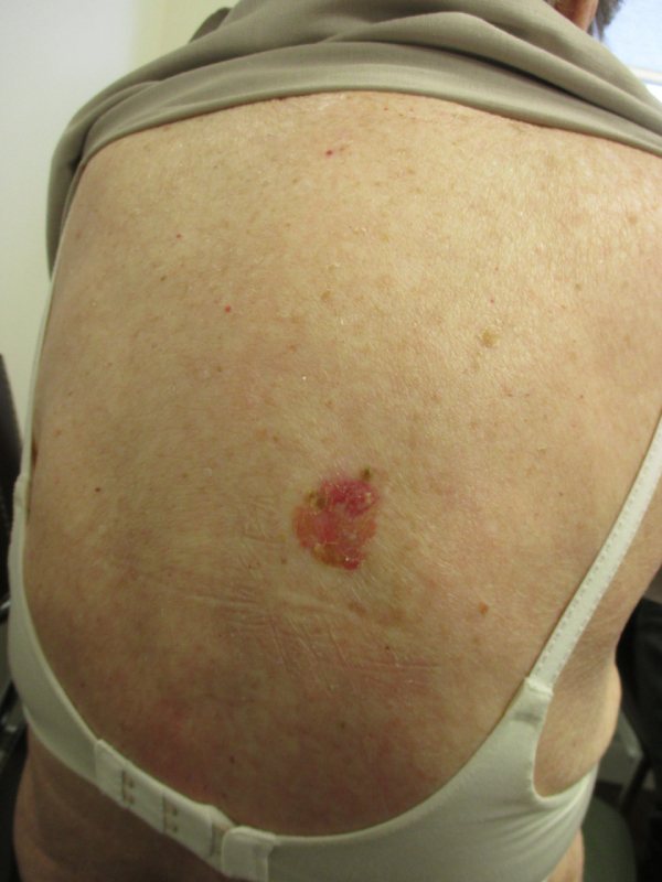 basal cell carcinoma on back