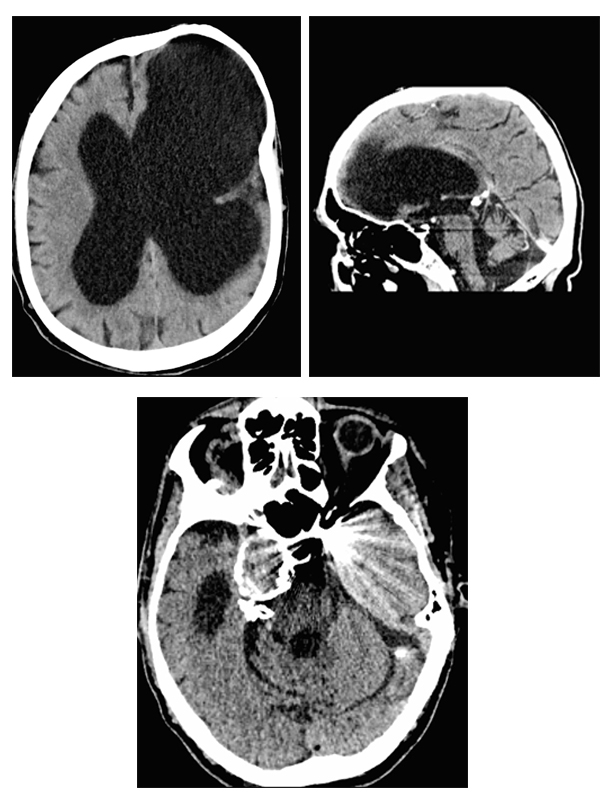 Severe Traumatic Brain Injury (TBI) with Late Cognitive and Functional ...