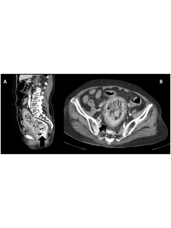 Stercoral Colitis | International Journal of Clinical & Medical Images