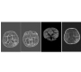Cytomegalovirus Encephalitis in an Infant; MRI Manifestation: A Clinical Image