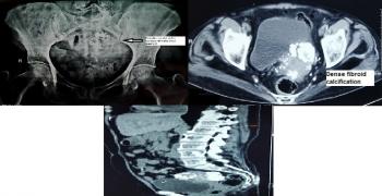 A Rare Presentation of Primary Hyperparathyroidism - Massive Uterine
Fibroid Calcification