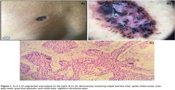 Basal Cell Carcinoma: An Unusual Localization and a Typical Dermoscopy