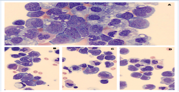 Myeloblasts in Pleural Effusion