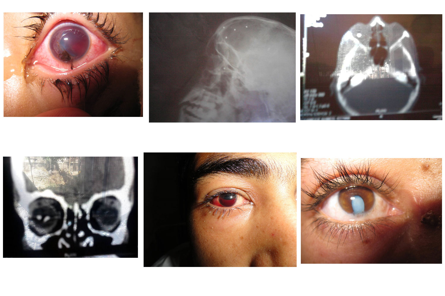 Pellet Gun Injury | International Journal Of Clinical & Medical Images