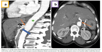 Anatomical Variant at Surgical Risk: Median Arcuate Ligament Syndrome