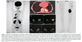A Case Report of Lung Cancer Acrometastases Revealed on 18FFDG PET/CT