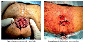 Surgical Management of Grade 4 Hemorrhoids: Before and After the Procedure