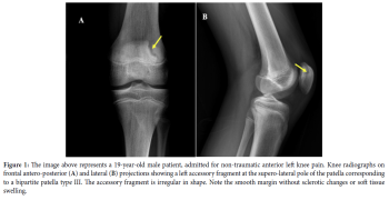 What can mimic a Patellar Fracture?